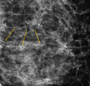 Arrows point to microcalcifications in a mammogram.Credits: Avice O’Connell, University of Rochester Medical Center